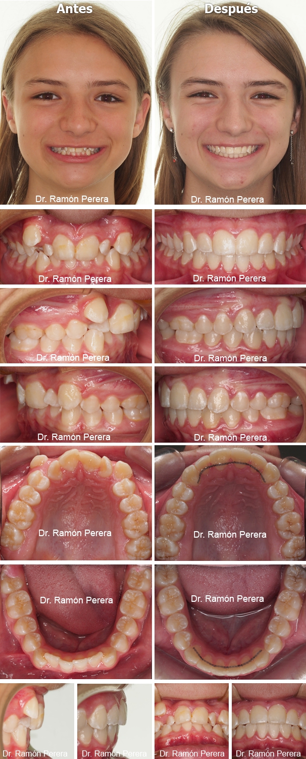 ortodoncia brackets albacete compresión de las arcadas