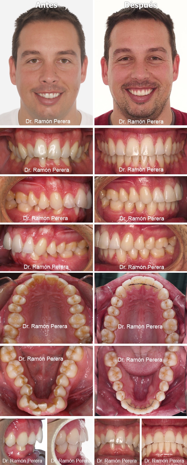 ortodoncia brackets albacete compresión de las arcadas