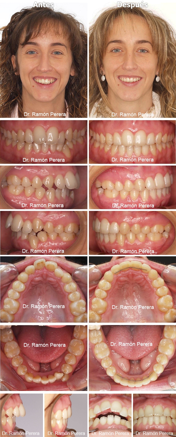 ortodoncia brackets albacete compresión de las arcadas