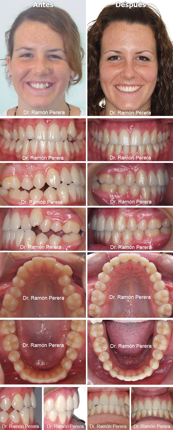 ortodoncia brackets albacete compresión de las arcadas