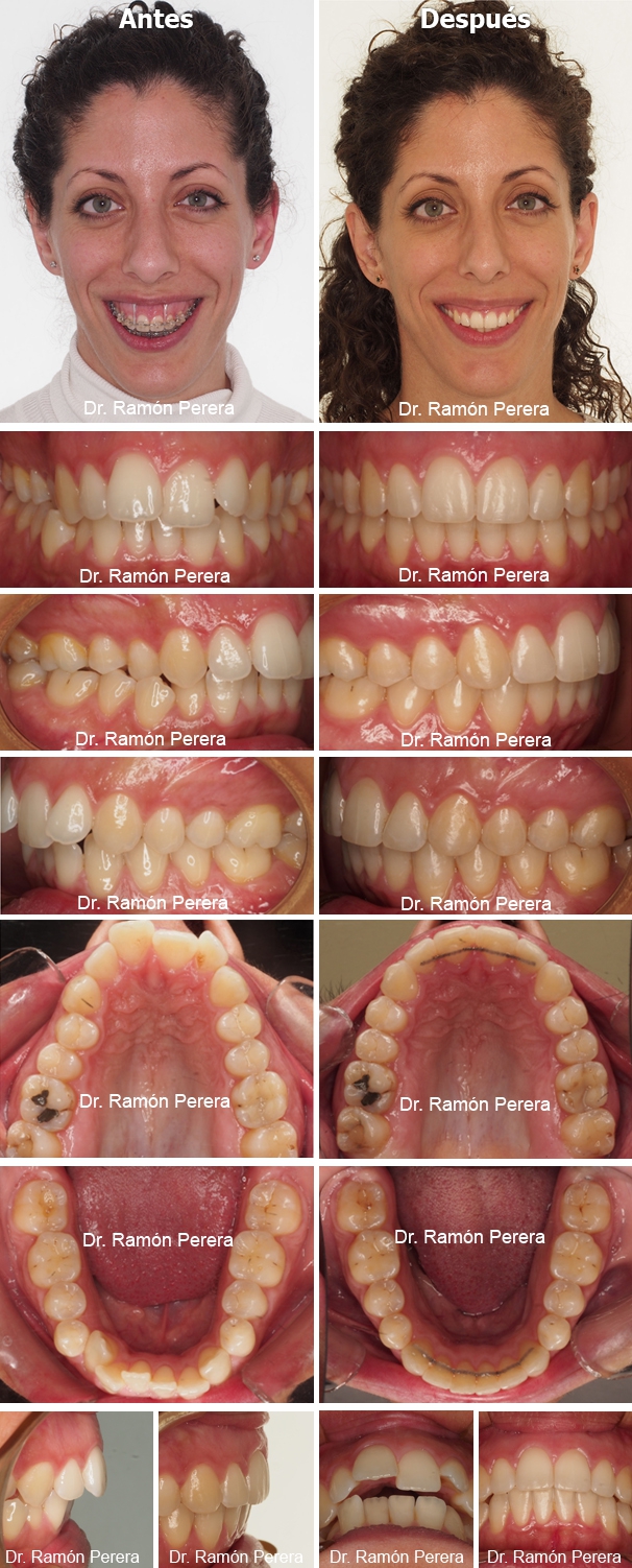 ortodoncia brackets albacete compresión de las arcadas