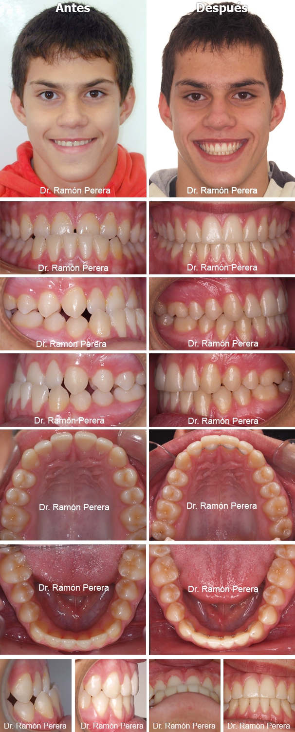 ortodoncia brackets albacete compresión de las arcadas