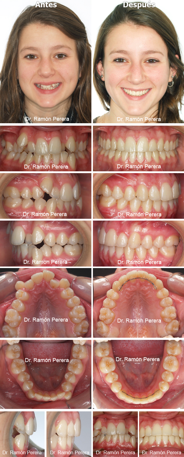Caso de ortodoncia resuelto con Sistema Damon en Ortodoncia Perera