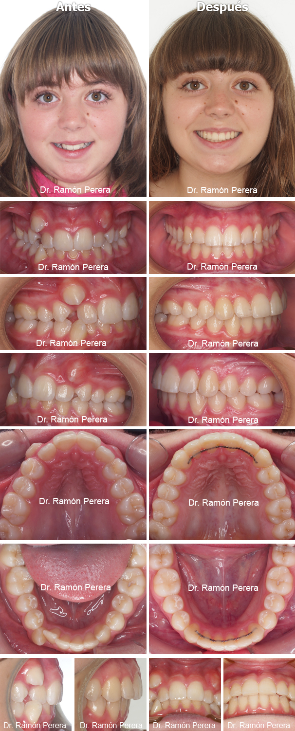 Caso de ortodoncia resuelto con Sistema Damon en Ortodoncia Perera