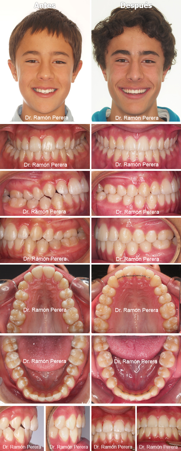 Caso de ortodoncia resuelto con Sistema Damon en Ortodoncia Perera