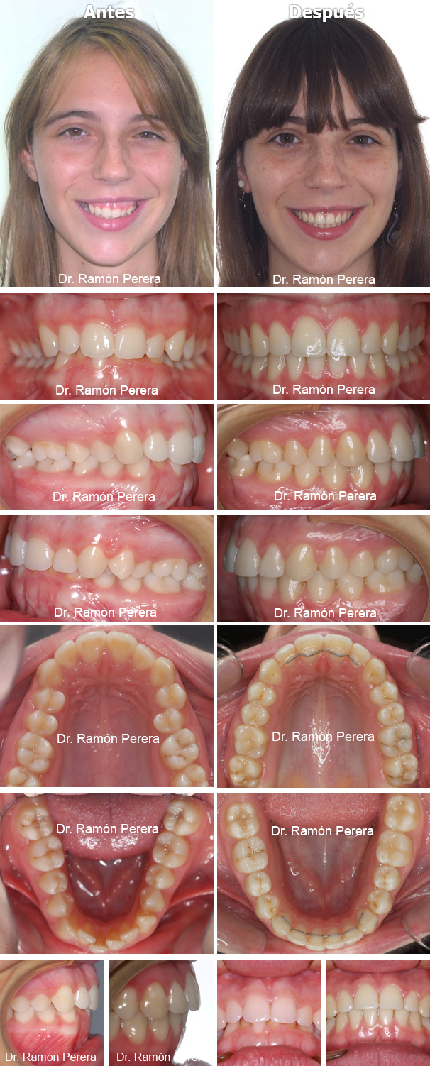 ortodoncia brackets albacete compresión de las arcadas