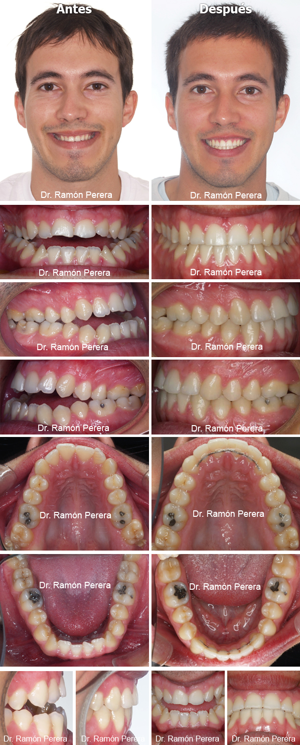 Caso de ortodoncia resuelto con Sistema Damon en Ortodoncia Perera