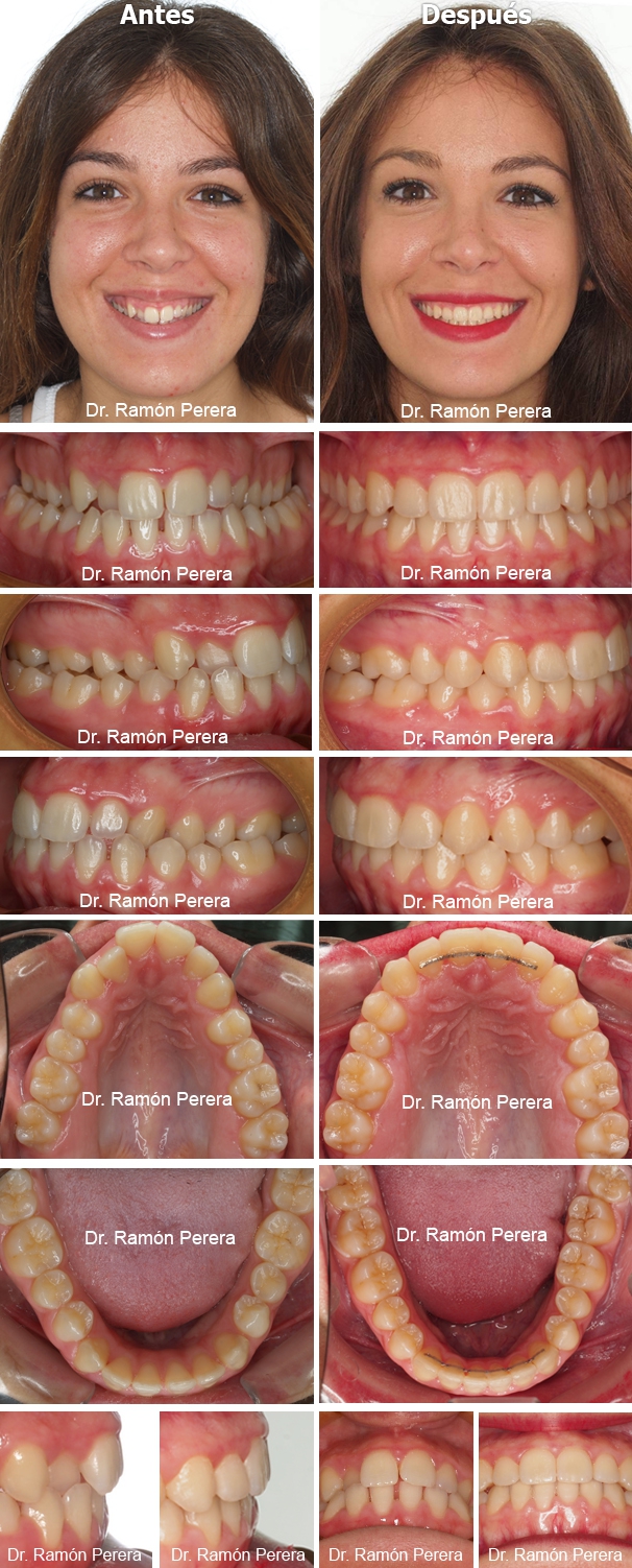 ortodoncia brackets albacete compresión de las arcadas