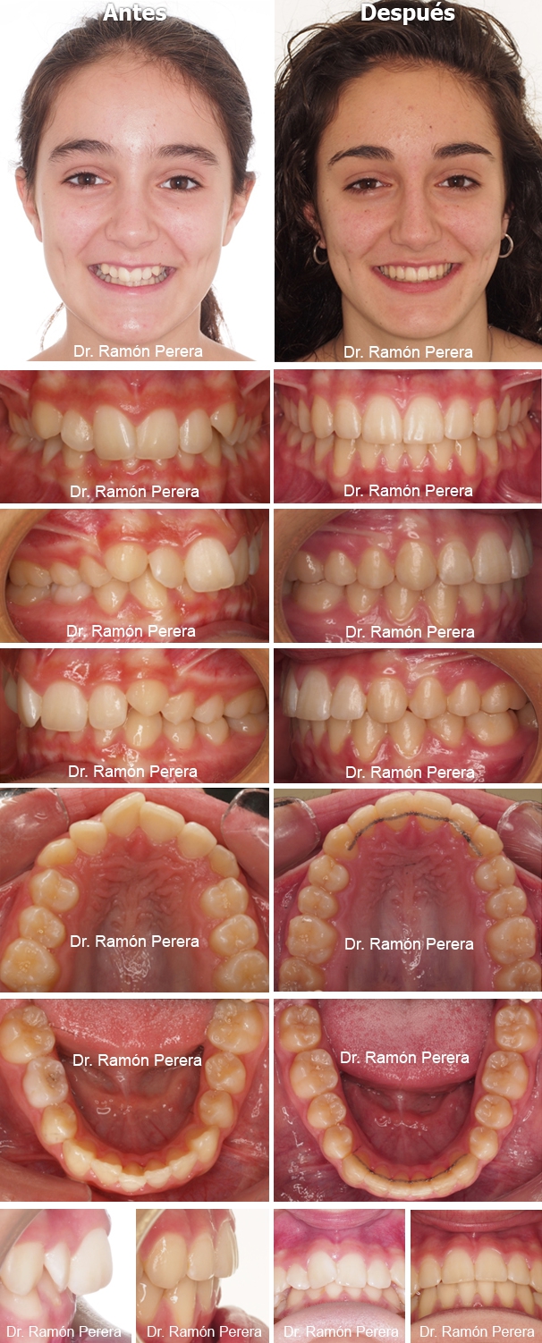 ortodoncia brackets albacete compresión de las arcadas