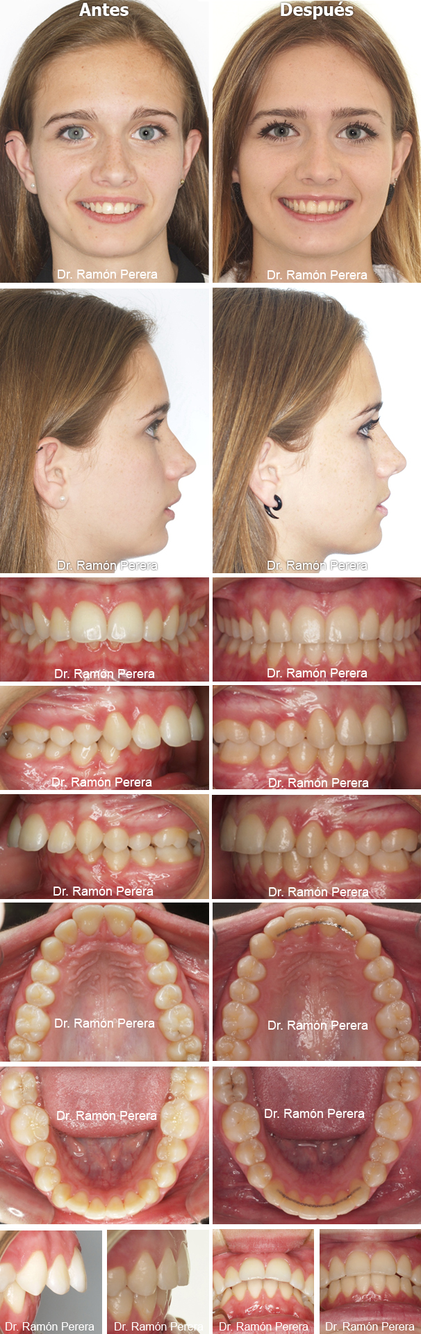 Clase II por déficit mandibular