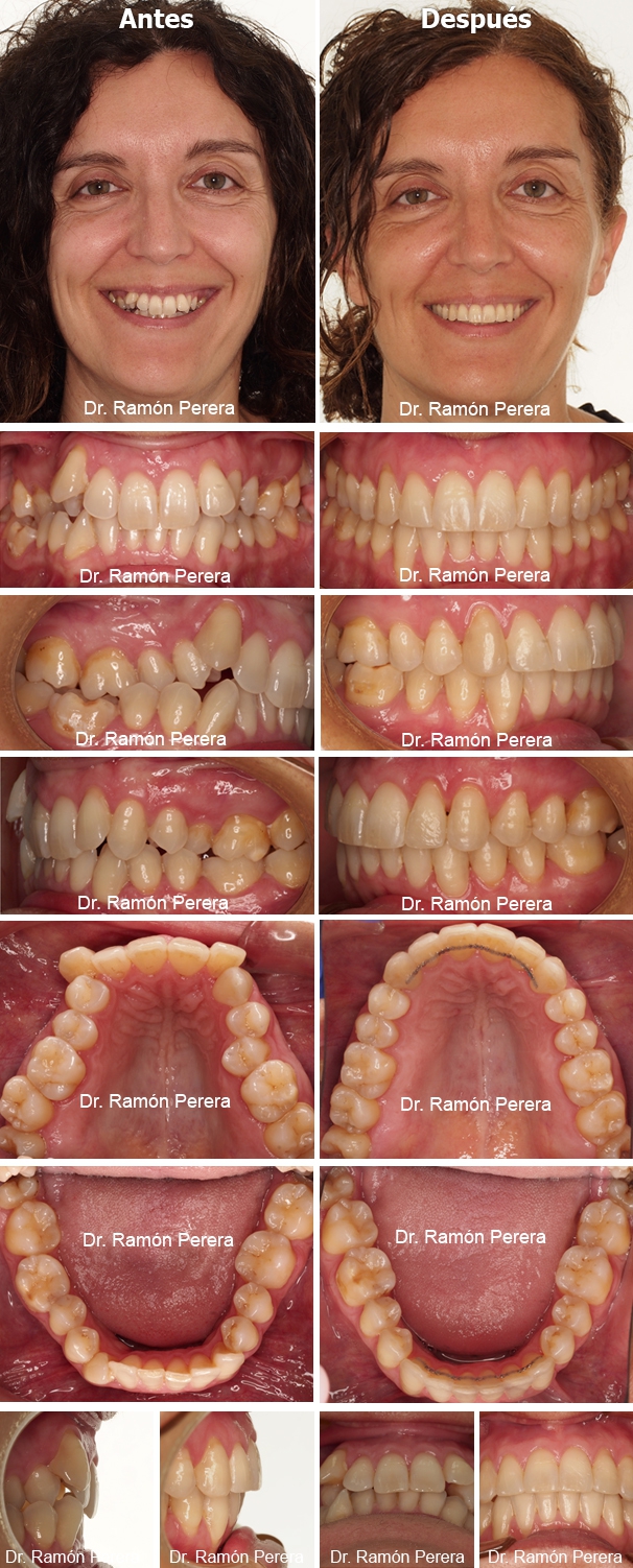 ortodoncia brackets albacete compresión de las arcadas