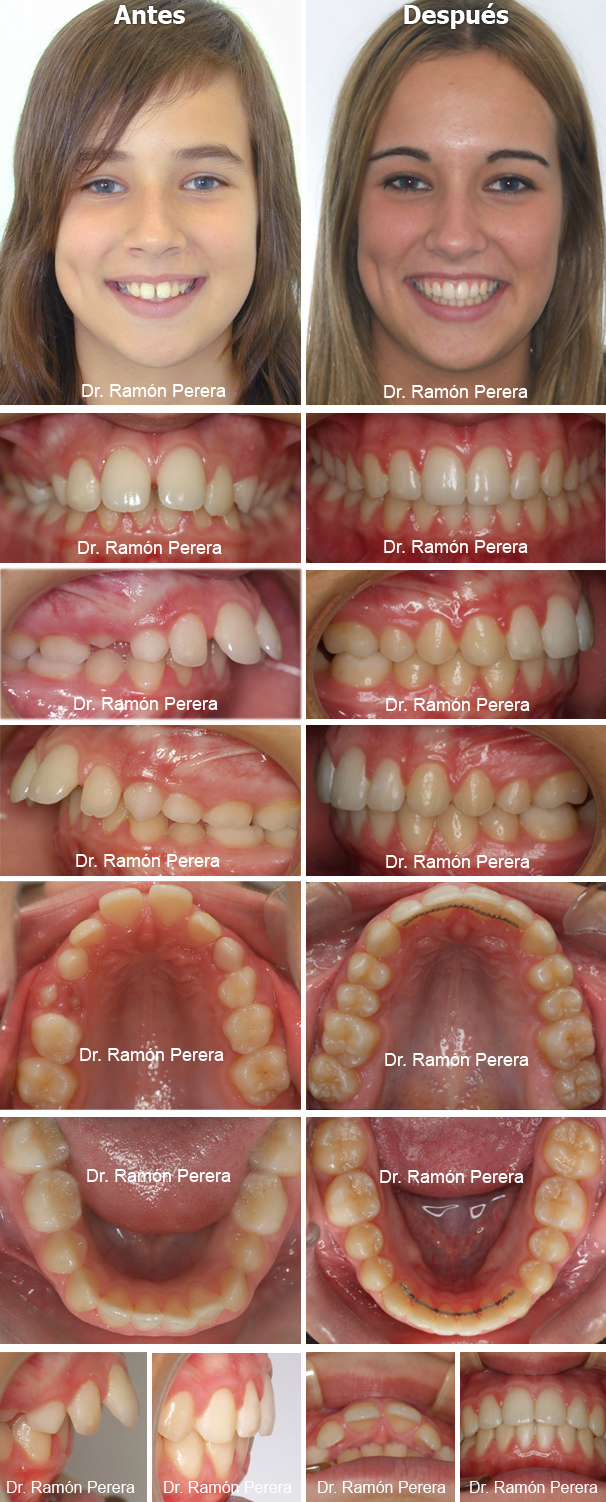 Caso de ortodoncia resuelto con Sistema Damon en Ortodoncia Perera