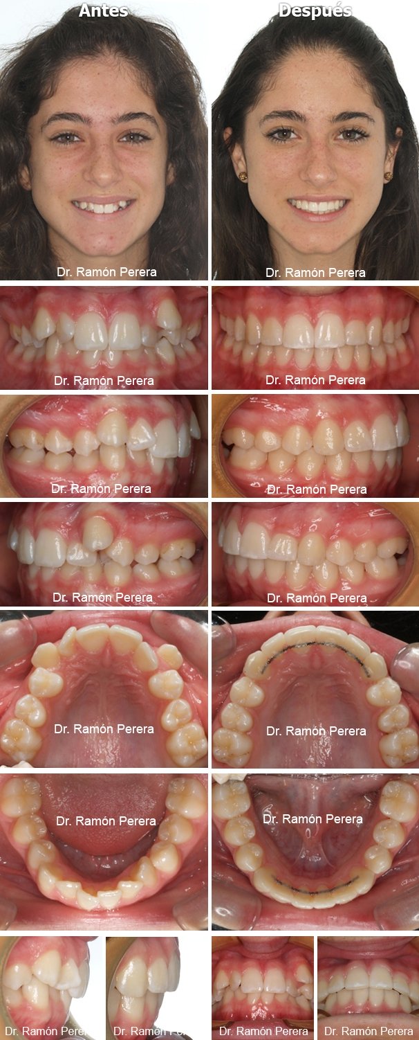 ortodoncia brackets albacete compresión de las arcadas