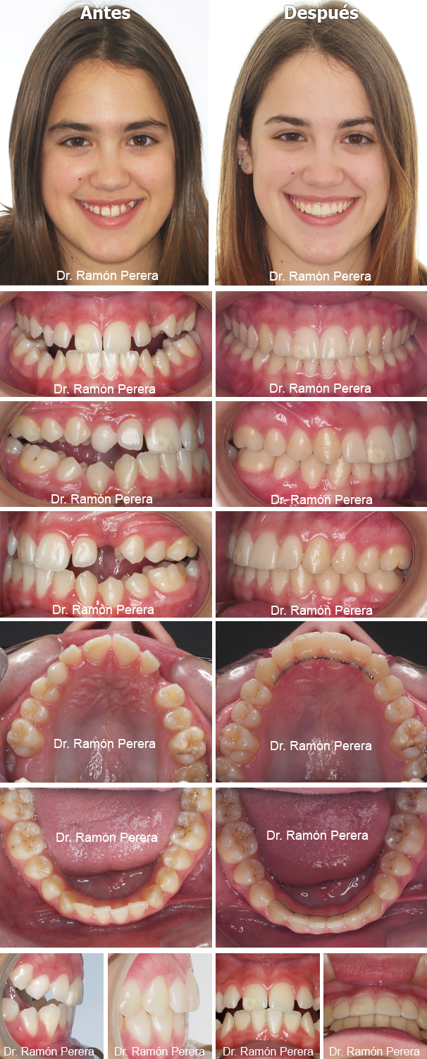 Caso de ortodoncia resuelto con Sistema Damon en Ortodoncia Perera