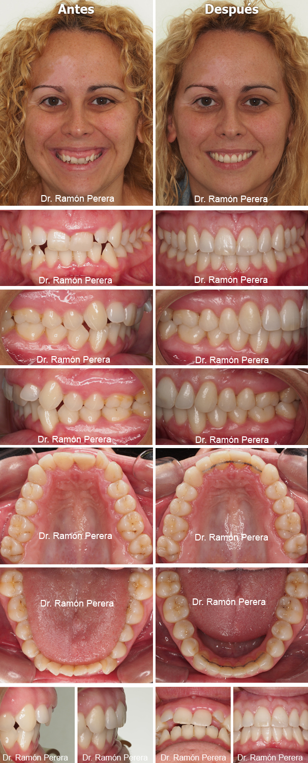 Sonrisa gingival tratamiento sistema Damon