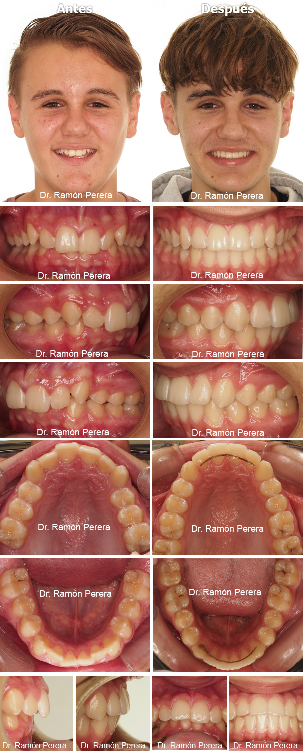 ortodoncia brackets albacete compresión de las arcadas