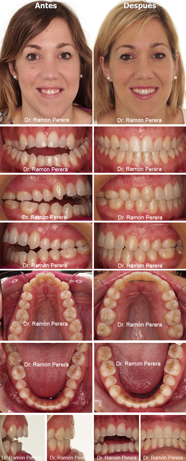 ortodoncia brackets albacete compresión de las arcadas